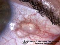 Conjunctival Cysts